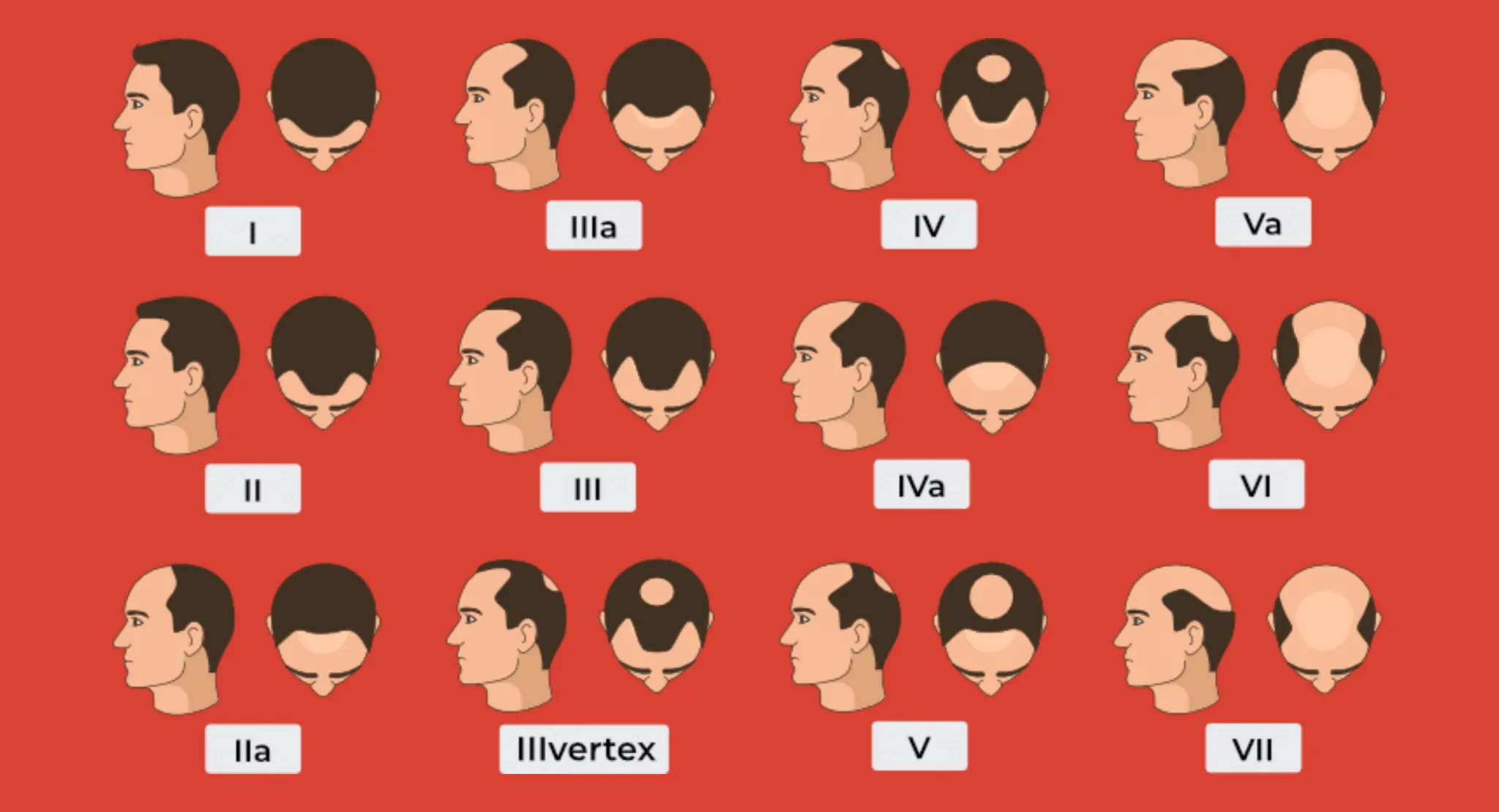 Łysienie typu męskiego klasyfikuje się tzw. Skalą Norwooda-Hamiltona
